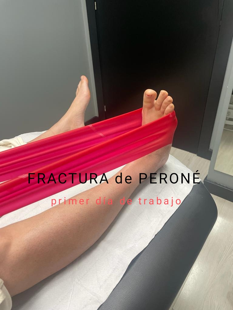 Se ven las piernas desnudas de rodilla para abajo de una paciente, tumbada en una camilla. En la derecha tiene una banda elástica roja enganchada en el pie, que sube hacia la cadera. Hay un texto que pone Fractura de peroné, primer día de trabajo